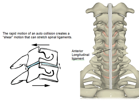 Whiplash weakens the neck